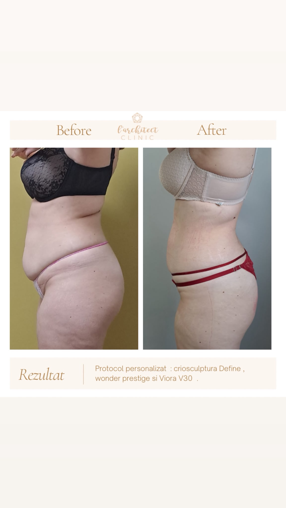 Criosculptură + Wonder Prestige + Viora V30