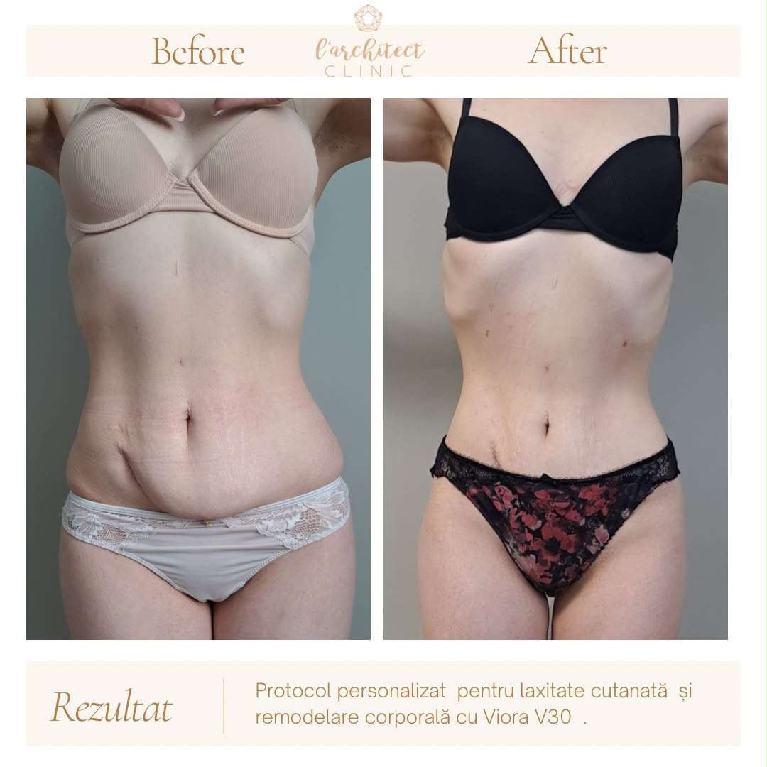 Laxitate & remodelare — Viora V30