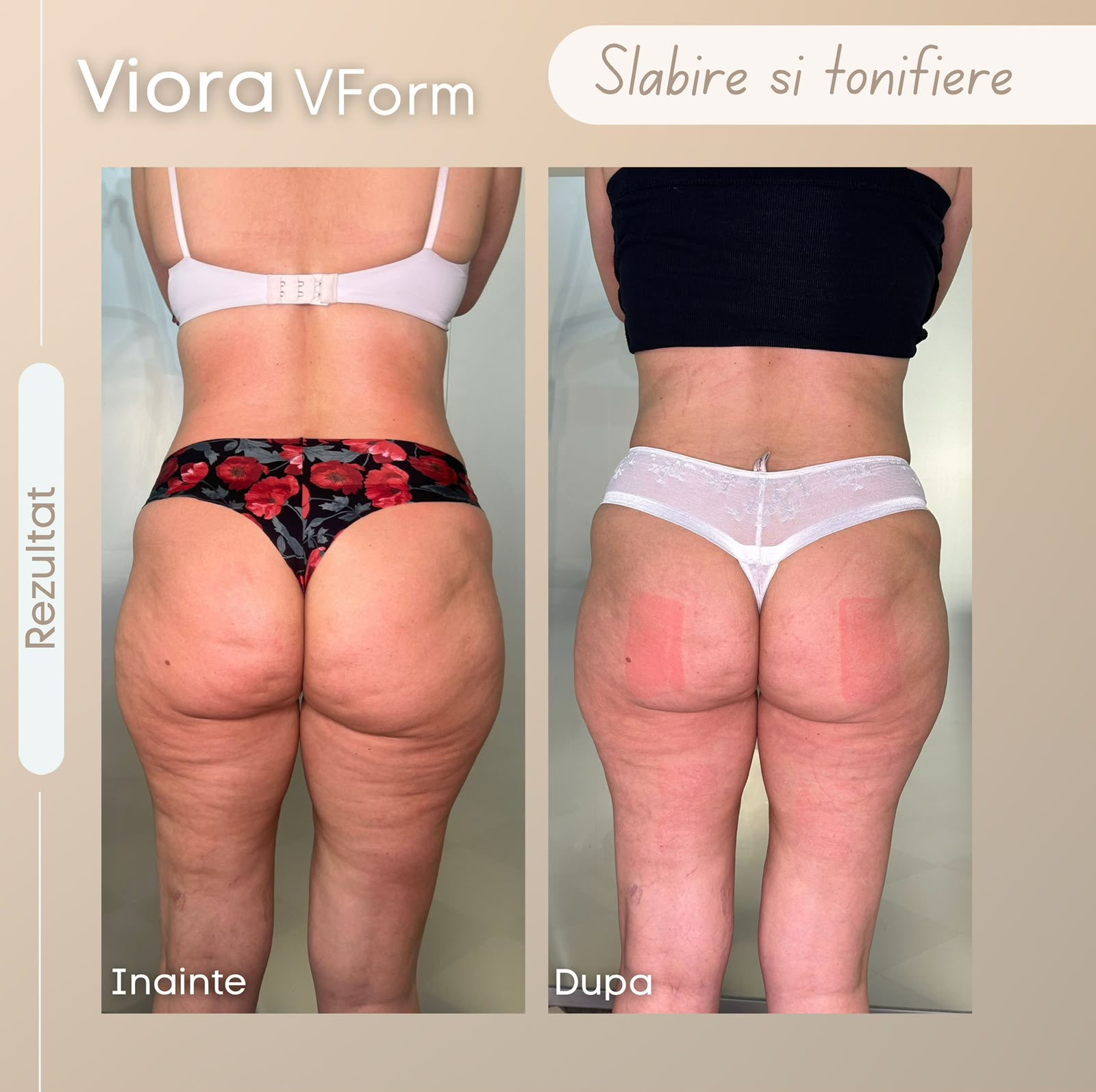 Viora V-Form — slăbire & tonifiere
