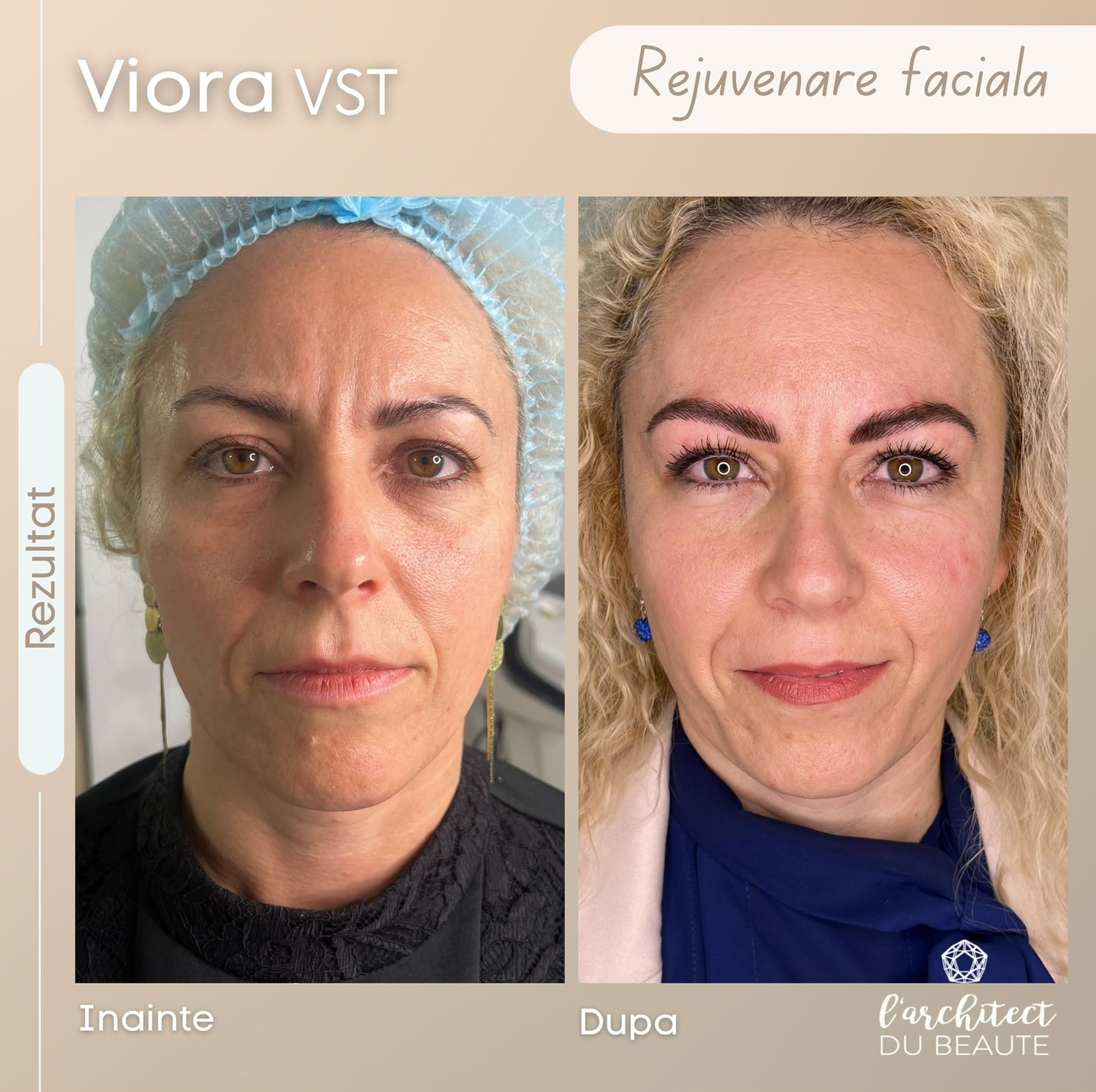 Viora VST — rejuvenare facială